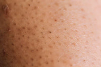 Ingrown marks
