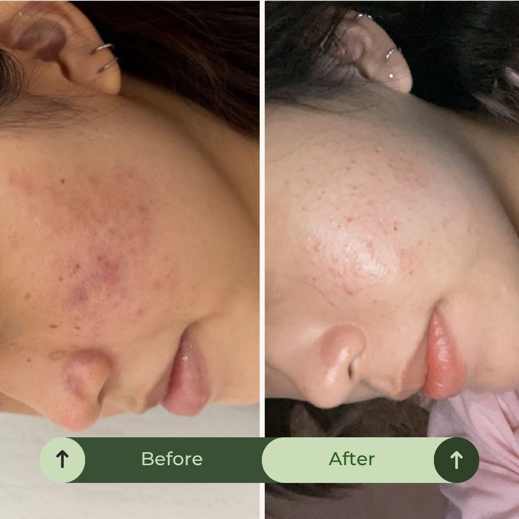 Acne & Blemish Control. Oil Balance. Mark Correction. Skin Repair