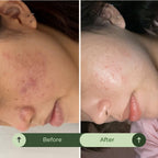 Acne & Blemish Control. Oil Balance. Mark Correction. Skin Repair