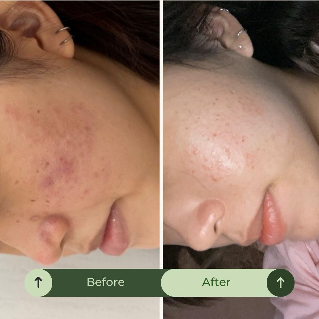 Acne & Blemish Control. Oil Balance. Mark Correction. Skin Repair