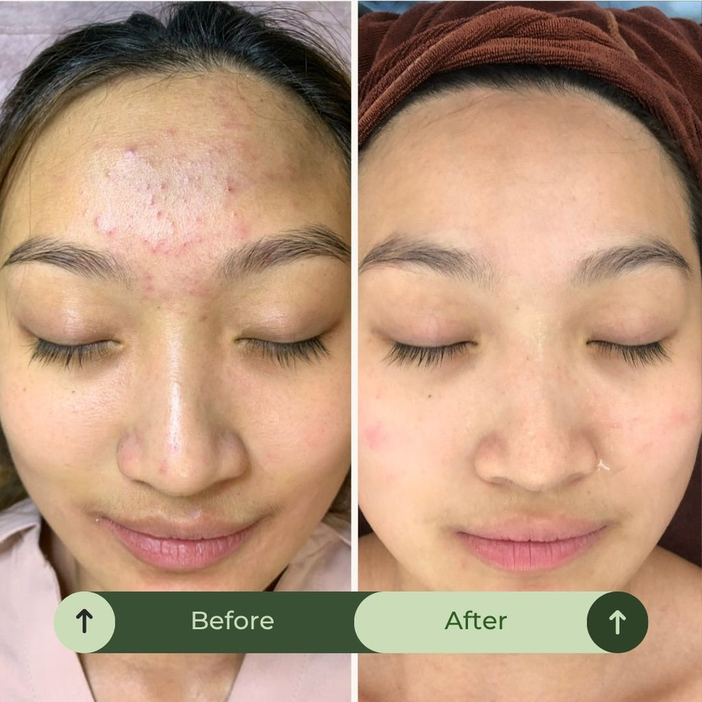 Acne & Blemish Control. Oil Balance. Mark Correction. Skin Repair