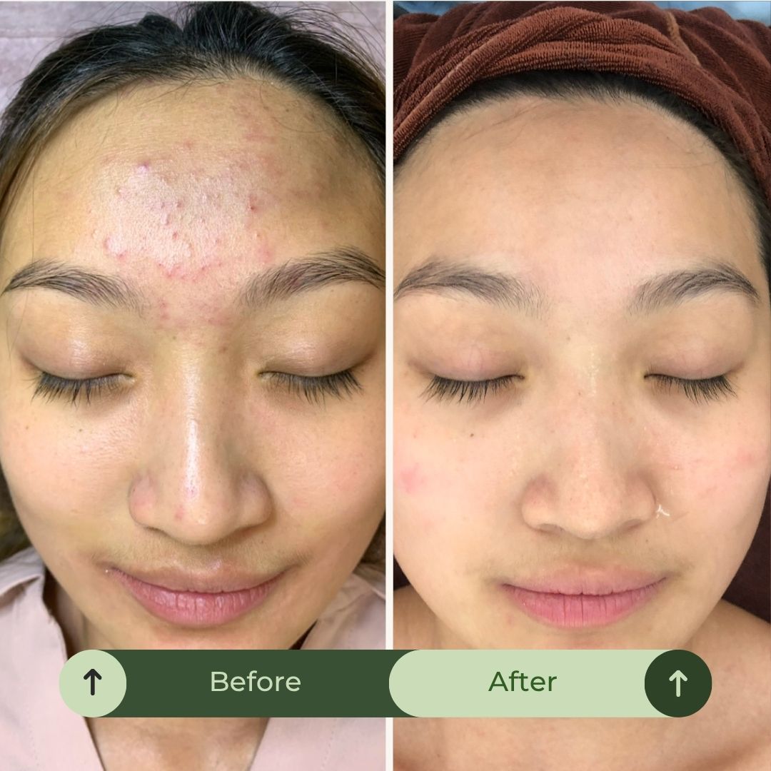Acne & Blemish Control. Oil Balance. Mark Correction. Skin Repair