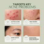 Acne & Blemish Control. Oil Balance. Mark Correction. Skin Repair