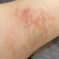 Redness after shaving
