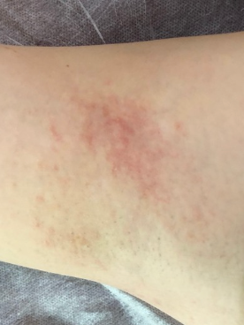 Left Underarm