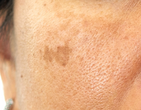 Pigmentation