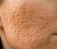 Enlarged Pores