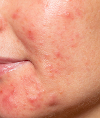 Acne & Blemishes