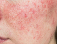 Inflammation & Redness