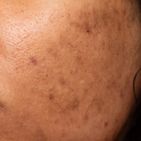 Acne Marks
