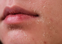 Sensitiive Skin