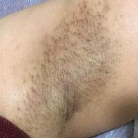 Dark underarms
